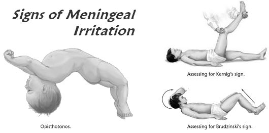 signs of meningeal irritation