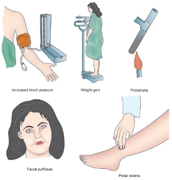 pre-eclampsia features