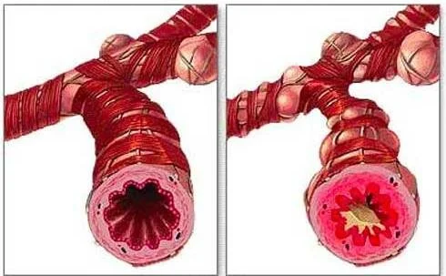 airway inflammation