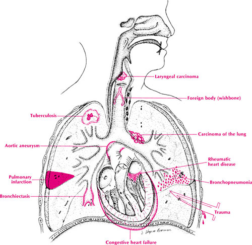 hemoptysis causes