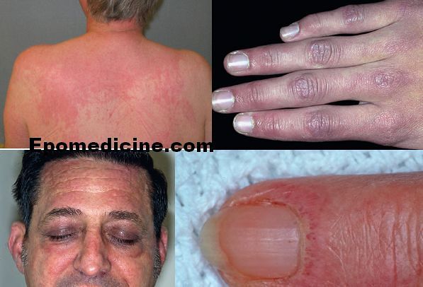 Dermatomyositis skin