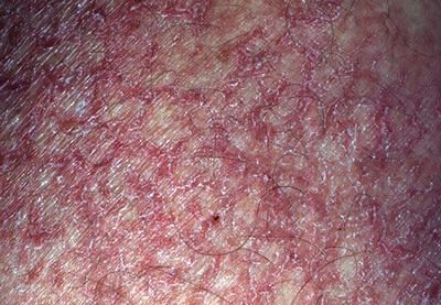 eczema skin treatment in  manifestation  thyroid Cutaneous disorders Epomedicine