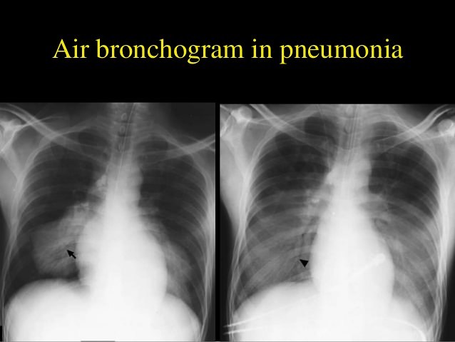 Air Bronchogram Vs Normal