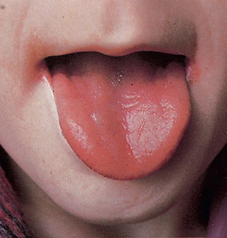 cheilitis and glossitis