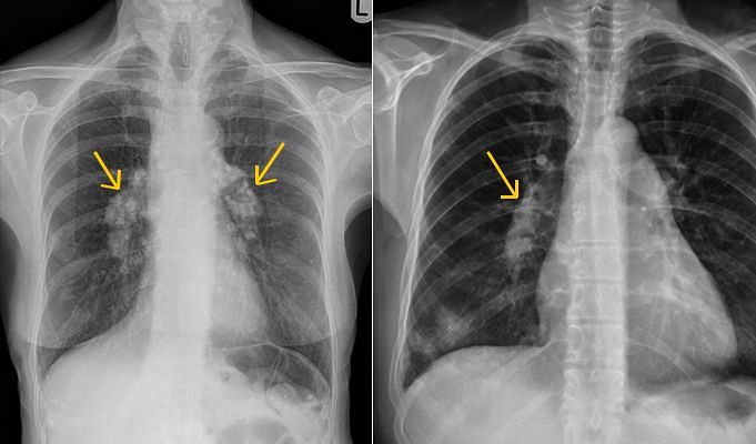 What Does A Hilar Shadow On A Chest X Ray Indicate FMXR What Does A Hilar Shadow On A Chest X Ray Indicate FMXR