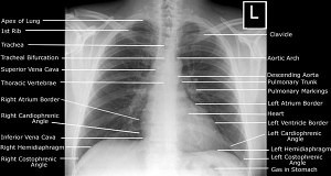 Systematic Approach to Frontal Chest X-ray | Epomedicine