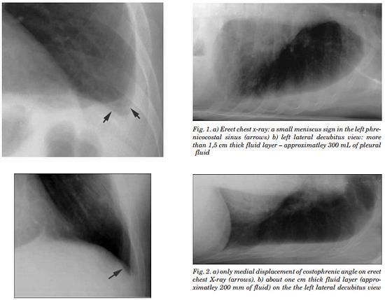 chest x ray pleural effusion