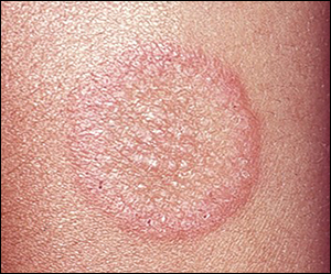 Dermatology Internship : 5 Common Skin Diseases Seen | Epomedicine