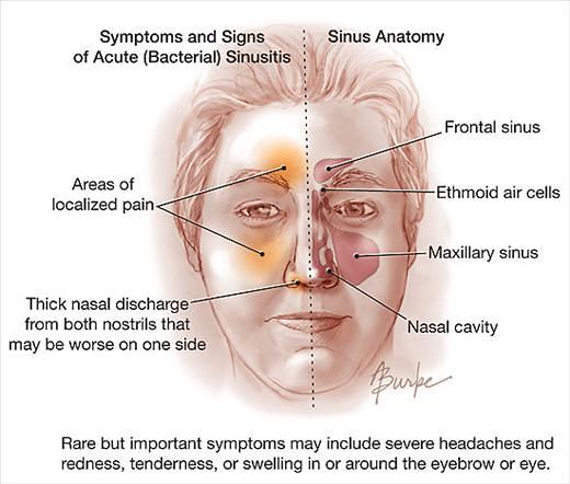 Acute Rhinosinusitis Ars Clinical Guidelines Epomedicine