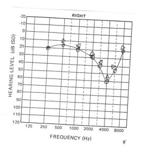 Pure Tone Audiogram and Interpretation | Epomedicine