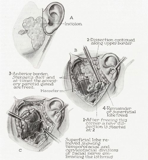 parotidectomy steps