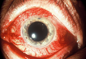 ciliary flush vs conjunctivitis