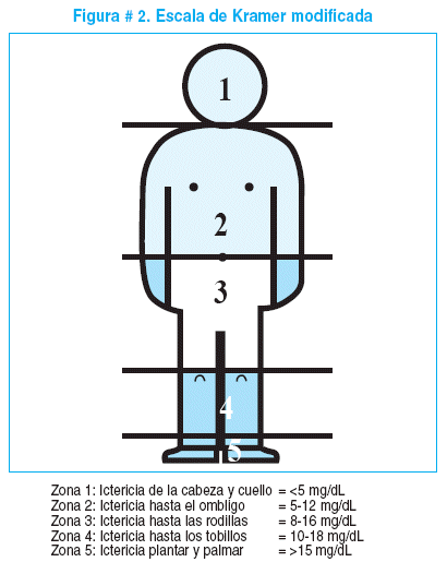 Neonatal Jaundice Chart - Jaundice Neonatal