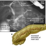 ERCP in pancreatitis