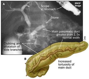 chronic pancreatitis ercp