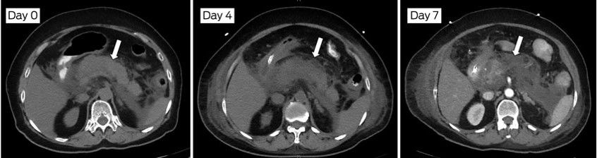 progressive pancreatic necrosis in CT