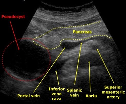 Pancreatic pseudocyst ultrasonography