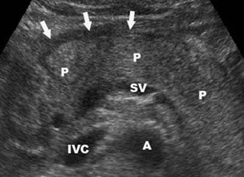 acute pancreatitis ultrasonography