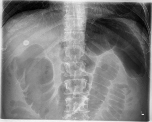 colon cutoff sign acute pancreatitis