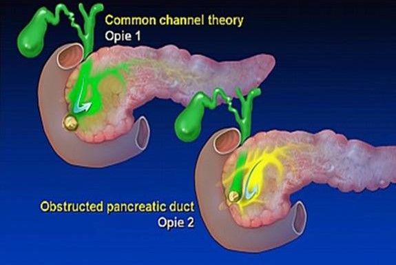 biliary pancreatitis mechanism