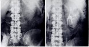 renal halo sign pancreatitis