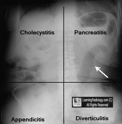 renal halo sign in acute pancreatitis