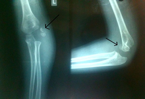 lateral condyle fx humerus closed