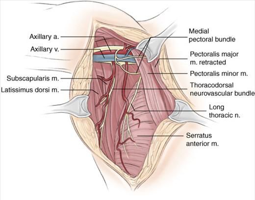 thoracodorsal nerve axillary dissection