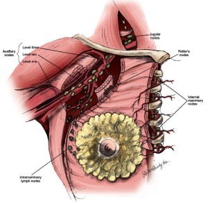 Axillary Lymph Node Dissection | Epomedicine