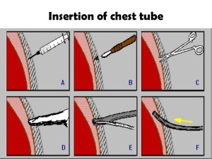 chest tube isnertion