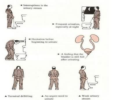 BPH symptoms