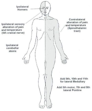 lateral brainstem syndrome