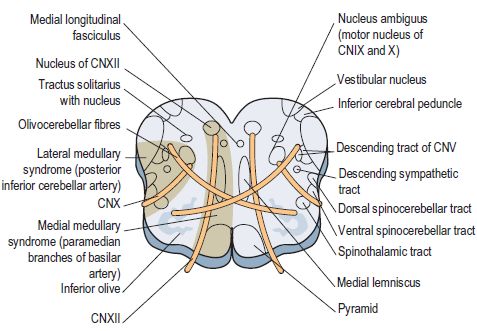 Anatomical basis of Wallenberg (Lateral Medullary) Syndrome