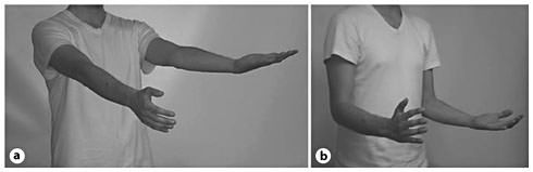 Pronator Drift Barre s sign Neurological Examination Epomedicine