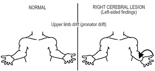 Pronator Drift Barre s sign Neurological Examination Epomedicine