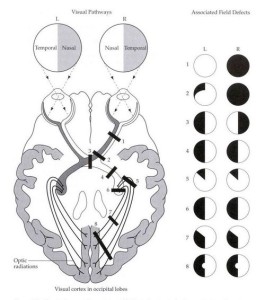 Craniopharyngioma - Case Discussion | Epomedicine