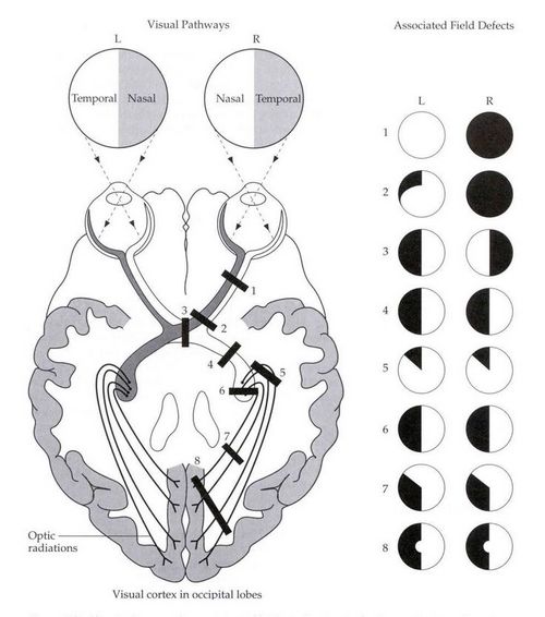 Visual Pathway With Lesions Ophthalmology Pinterest P - vrogue.co