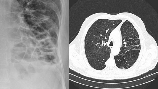 bronchiectasis imaging