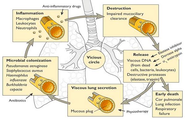 Bronchiectasis Revision Notes | Epomedicine