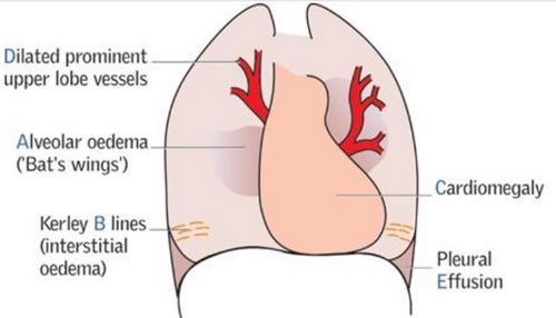 pulmonary edema mnemonics