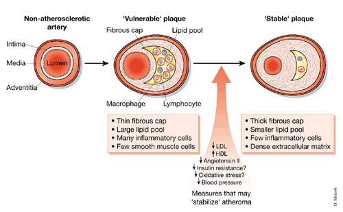 coronary artery disease pathophysiology diagram