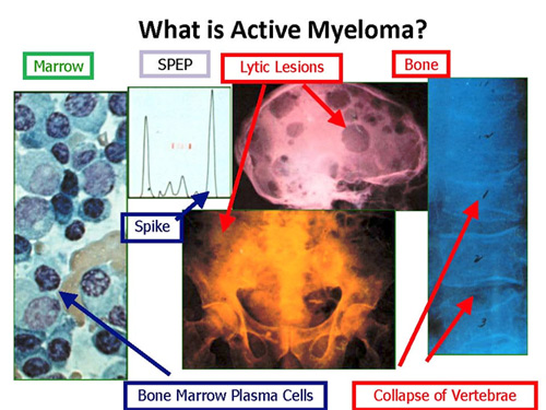 Multiple Myeloma : Quick Approach | Epomedicine