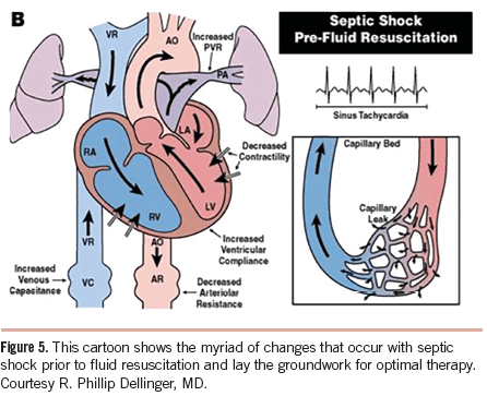 septic shock hemodynamic changes