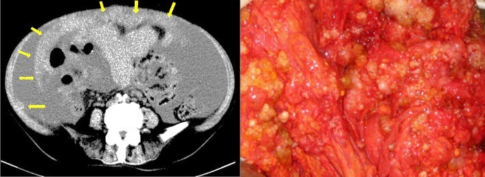 Omental cake | Image | Radiopaedia.org