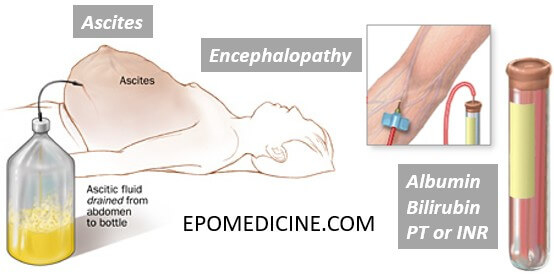 child-pugh-score-mnemonic-and-explanation-epomedicine