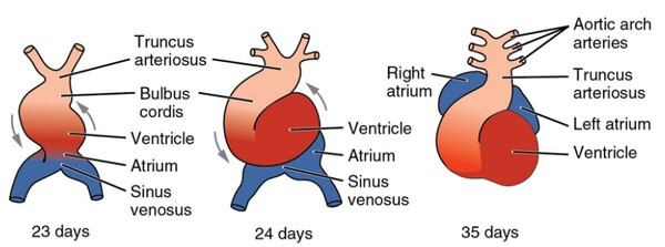 Aortic Vestibule Left Ventricle