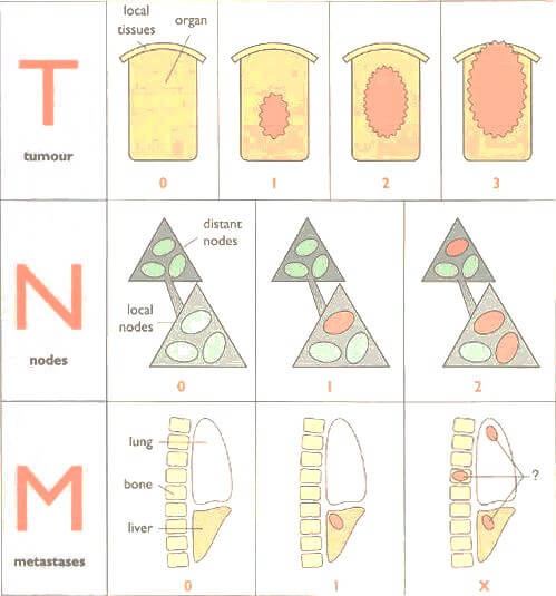 TNM staging for breast cancer