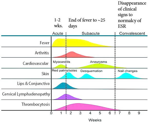 kawasaki-disease-clinical-phases