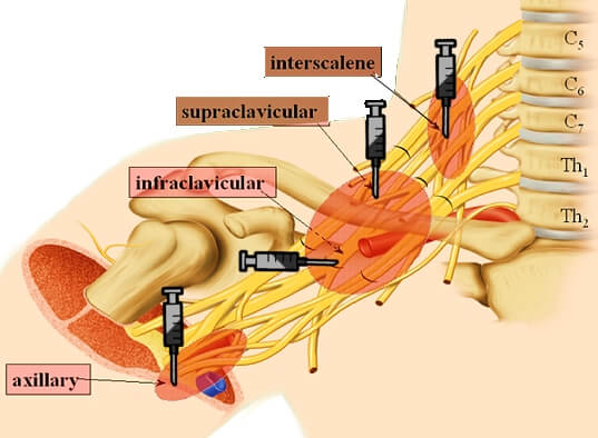 brachial-plexus-block-approaches