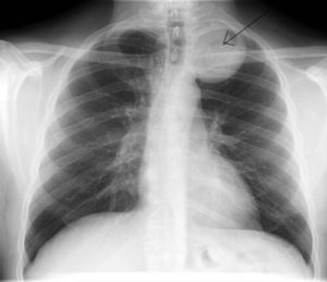 Stuart Sign Cervical Silhouette and Cervico-thoracic sign | Epomedicine